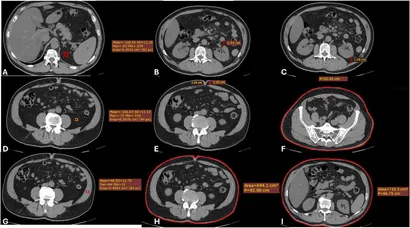【裁断済み】子宮体癌・卵巣癌におけるStaging Laparotomy 子宮体癌・卵巣癌におけるStaging Laparotomy